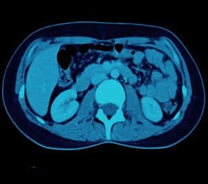 Preparation Low Dose Ct Scan Melbourne Radiology