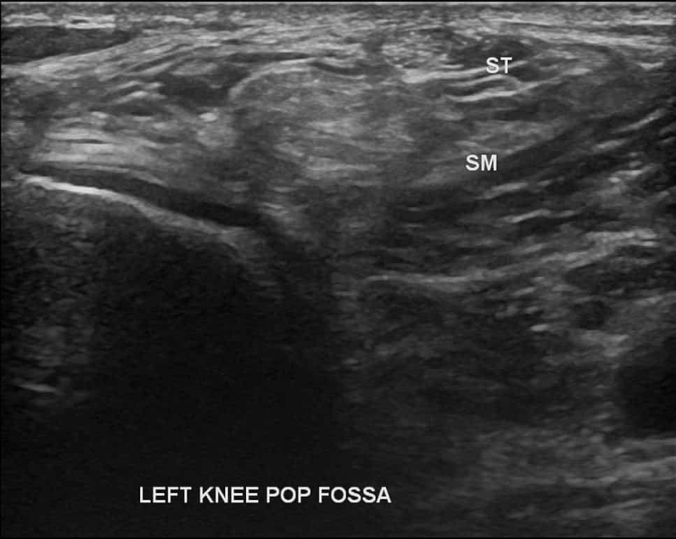 Knee Ultrasound Diagnostic Imaging Melbourne Radiology