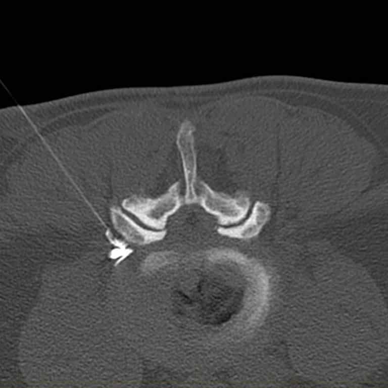 Selective Nerve Root Block Perineural Injection