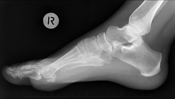 Digital X-ray Patient Fact Sheet - Melbourne Radiology