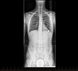 X Ray for Back Pain & Spinal Injuries | Melbourne Radiology