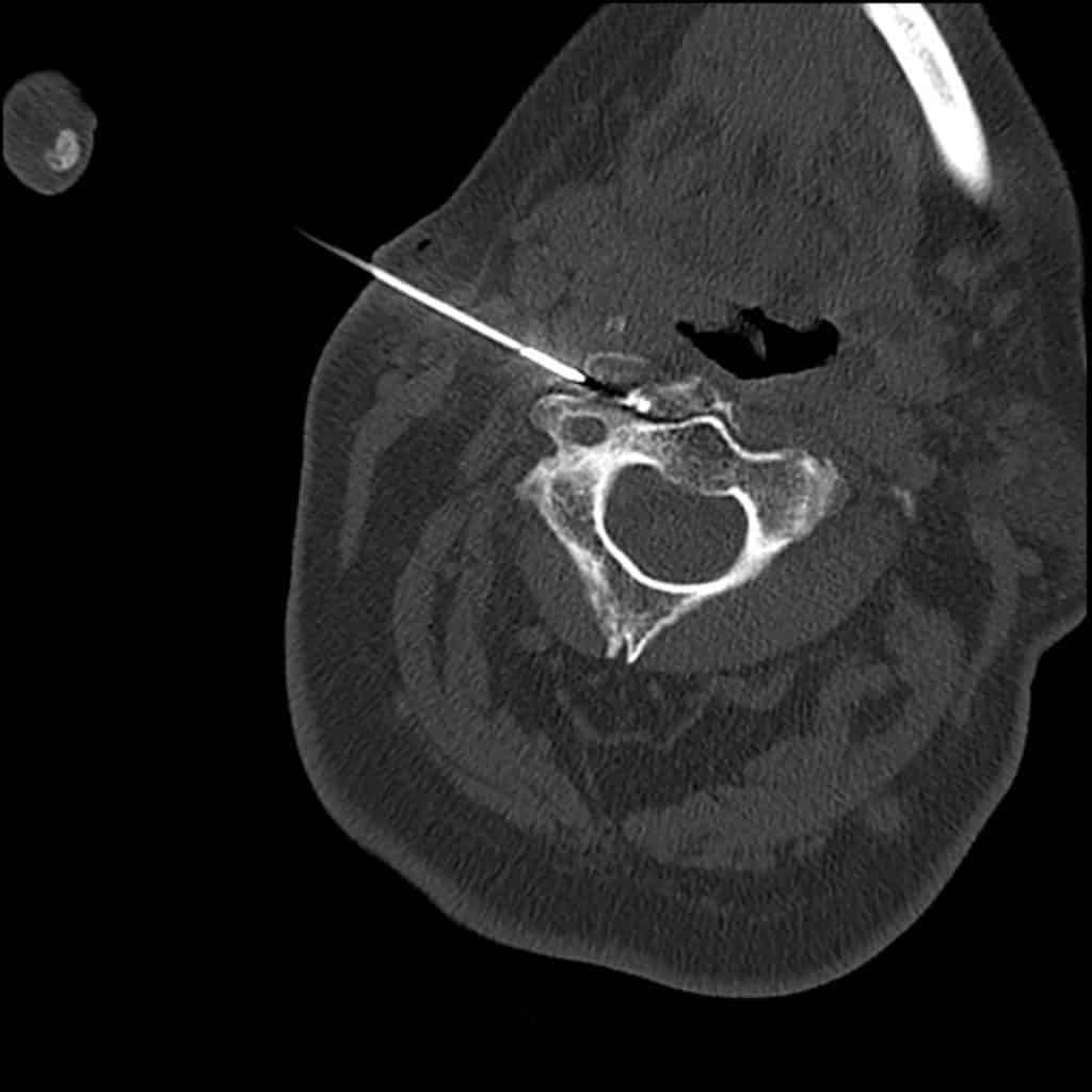 Radiofrequency Ablation Rfa Patient Fact Sheet