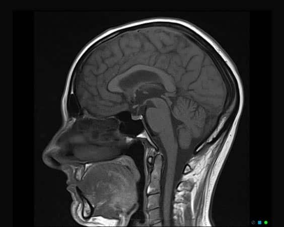 Magnetic Resonance Imaging (MRI) Adults Patient Fact Sheet