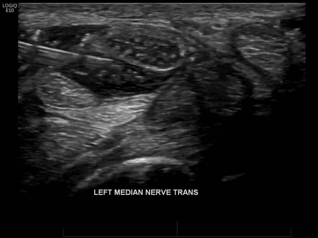 Pudendal Nerve Block Injection for Pain Management Melbourne