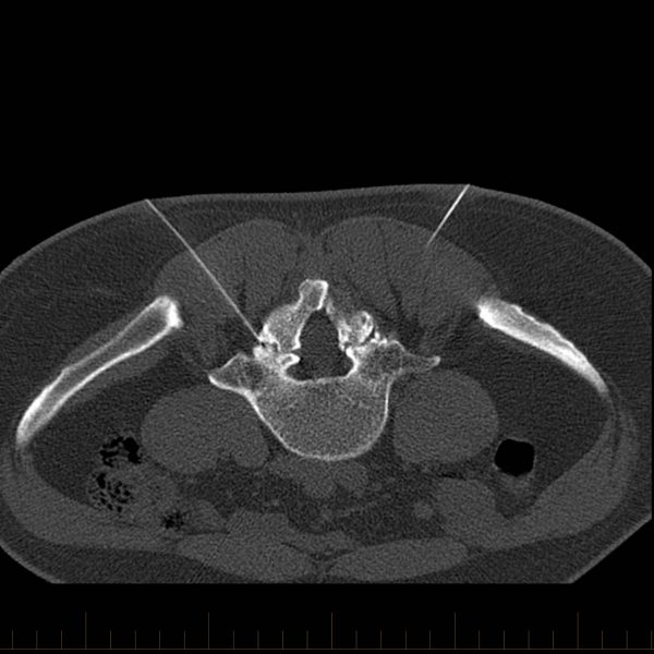 Spine & Back Pain - Pain Management Injections - Interventional Radiology