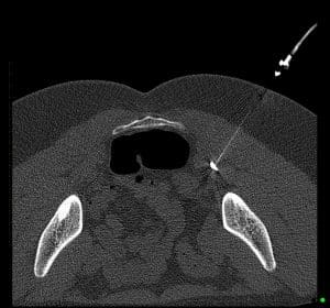 Piriformis Muscle Injection - CT guided injection - Melbourne Radiology