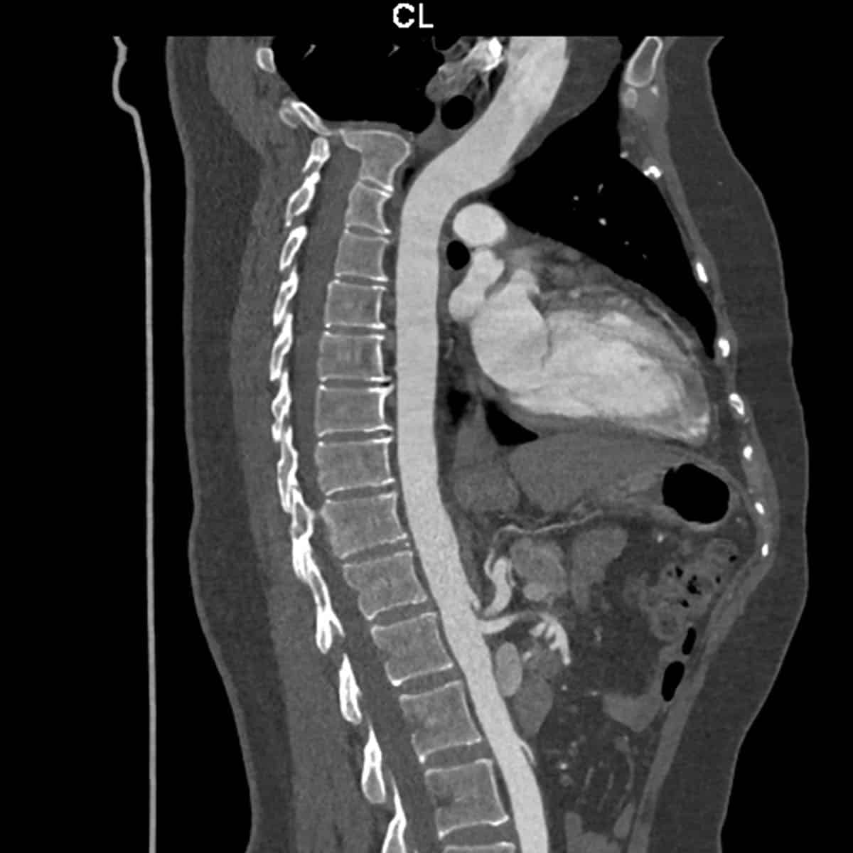 CT Scan Lumbar Spine - Diagnostic Imaging - Melbourne Radiology
