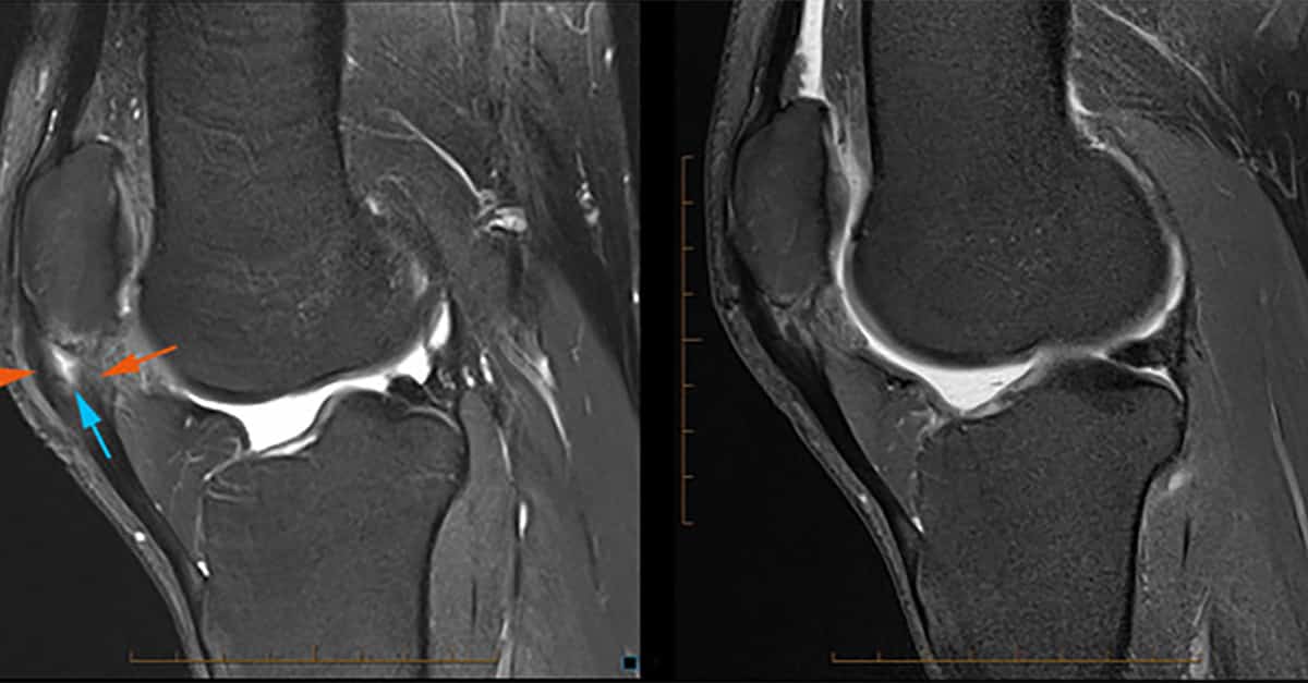 Autologous Tenocyte Implantation / Therapy (ATI/ATT)