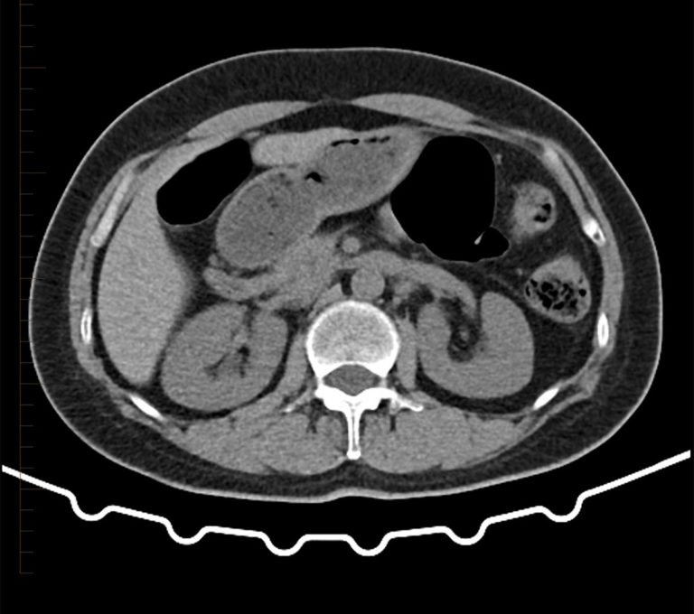 Ct Scan Of The Kidney 