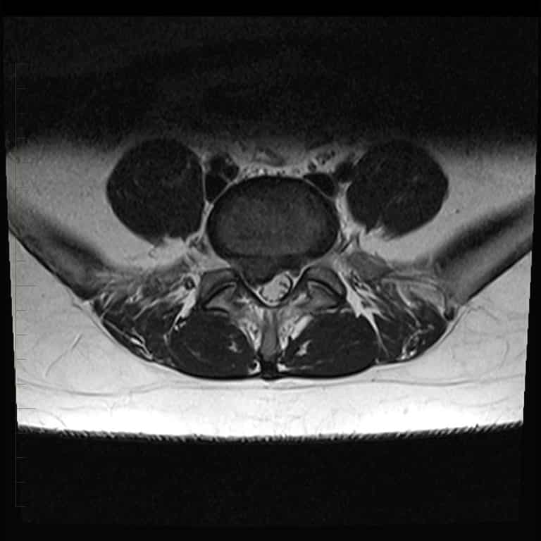 Mri Of The Lower Back Melbourne Radiology